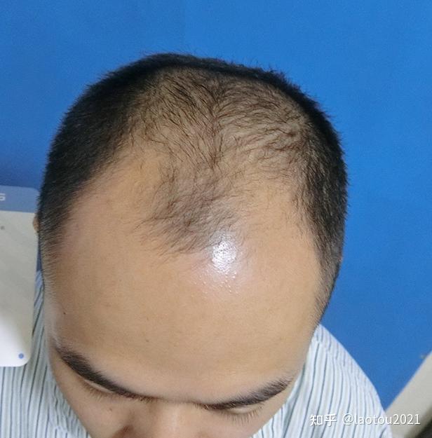 植发的危害须問华肤植发的简单介绍