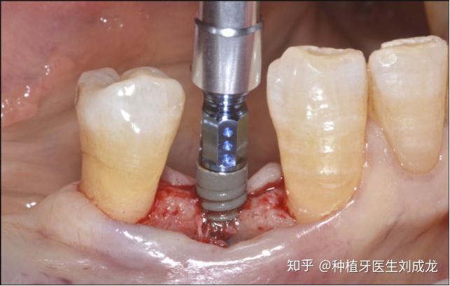 郑州瑞士iti亲水种植牙是怎样的体验主任医师或副主任医师做种植牙是