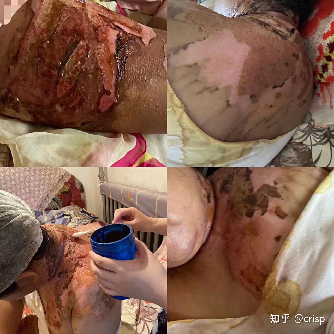 妹妹用热水泼自己亲姐姐致其重度烫伤 - 知乎