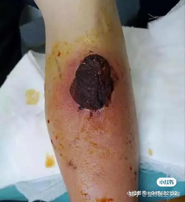 低温烫伤,不可不防! - 知乎