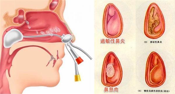 首大刘玉梅 确诊过敏性鼻炎要做哪些检查 知乎