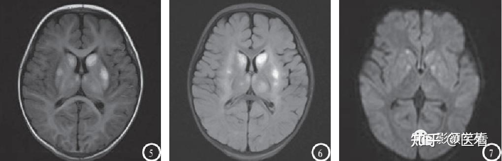 基底节区脑软化灶图片