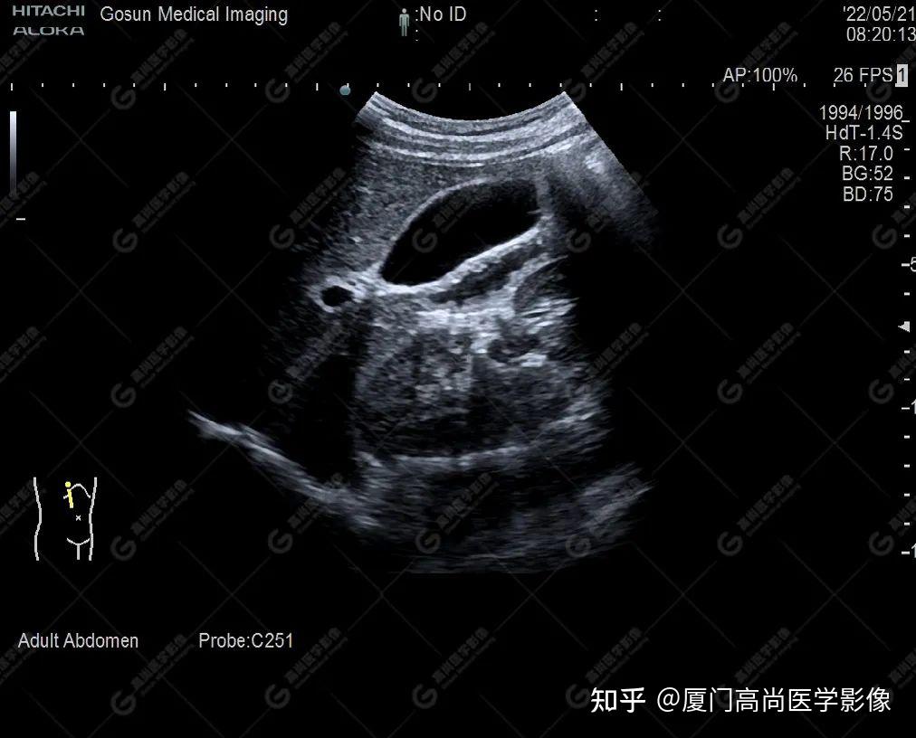 【高尚超声】超声药物性胆囊结石 - 知乎