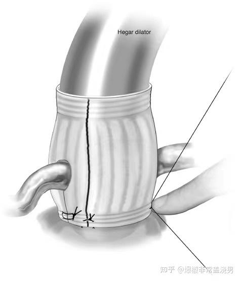 心脏大血管外科主动脉根部处理术式名称 - 知乎