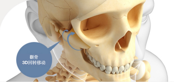 通过3d ct和invivo软件精密分析脸骨状态后,提前预测术后颧骨的立体感
