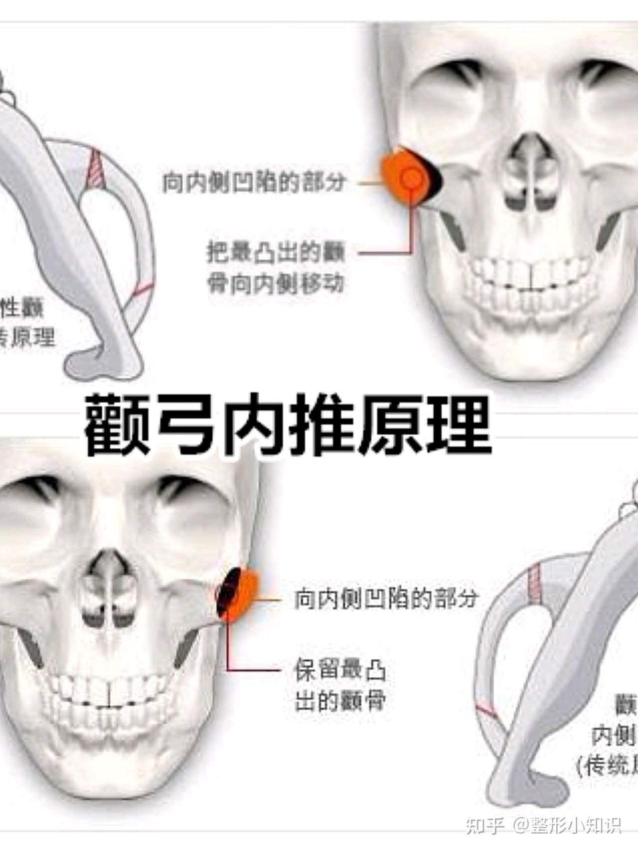 图解整形手术（1）：颧骨or颧弓 - 知乎