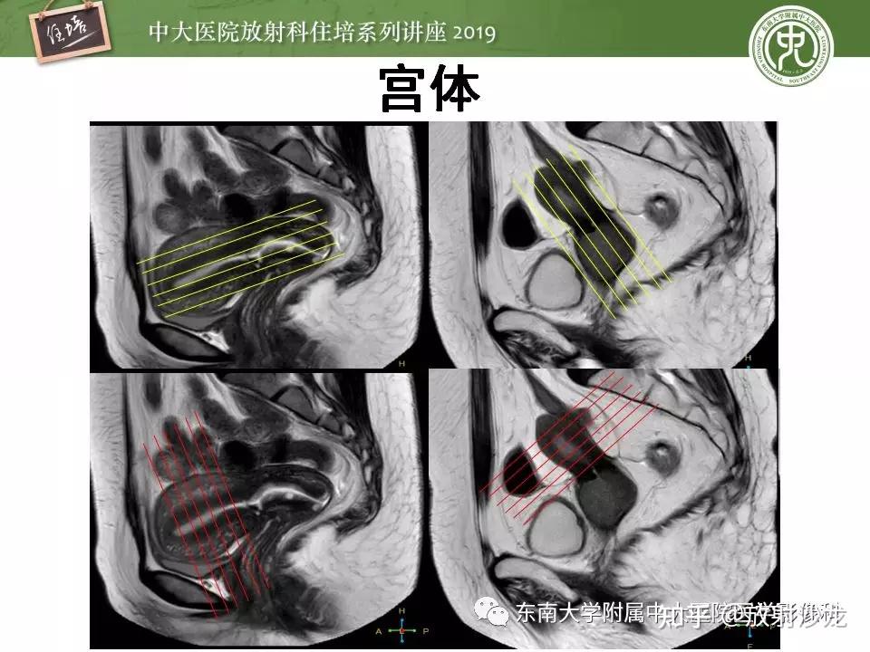 子宫详细解剖及磁共振信号分析 - 知乎