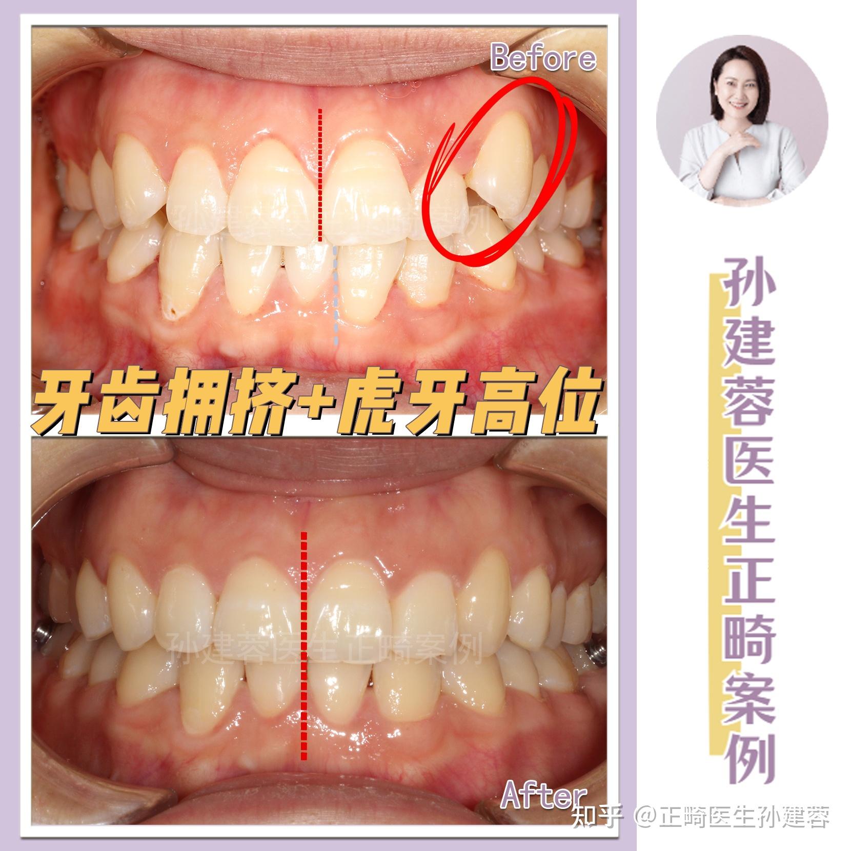 青島牙齒矯正片切推磨牙向後解決牙齒擁擠虎牙高位恢復流暢笑線