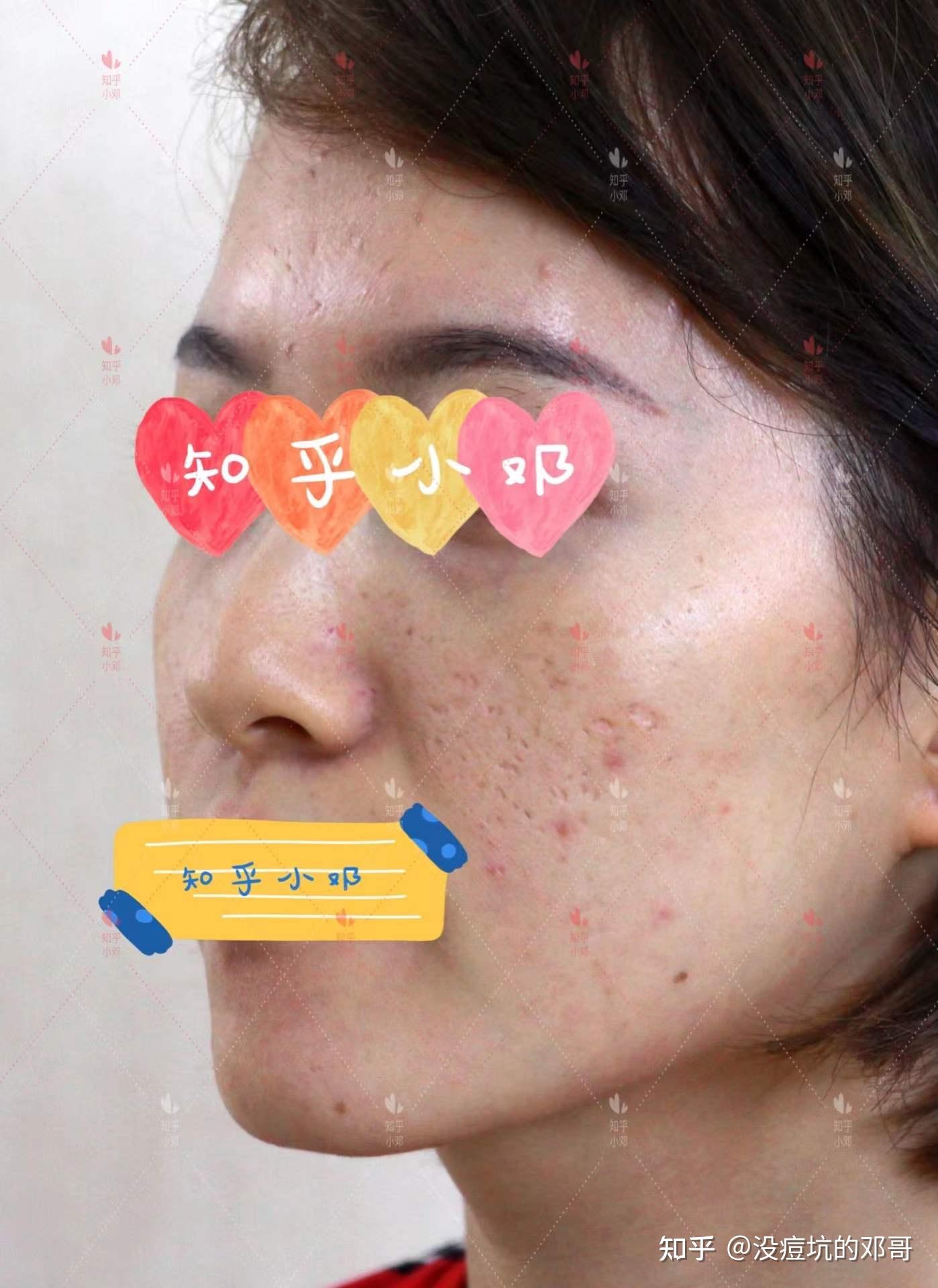 厢车型 冰锥型痘坑的混合型痘坑问题,做完一个疗程后的即刻效果反馈