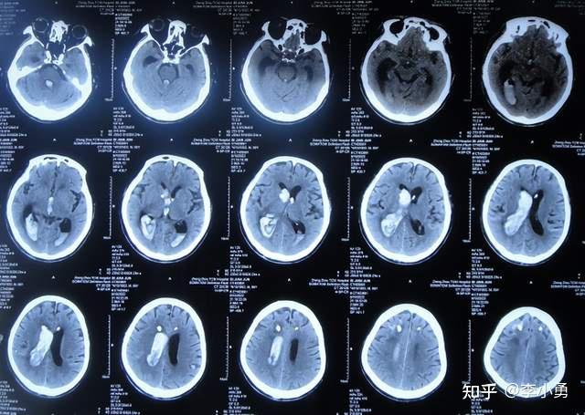 腦出血雙側引流術後繼發腦積水腰大池引流術後無效仍腦積水淺昏迷患者