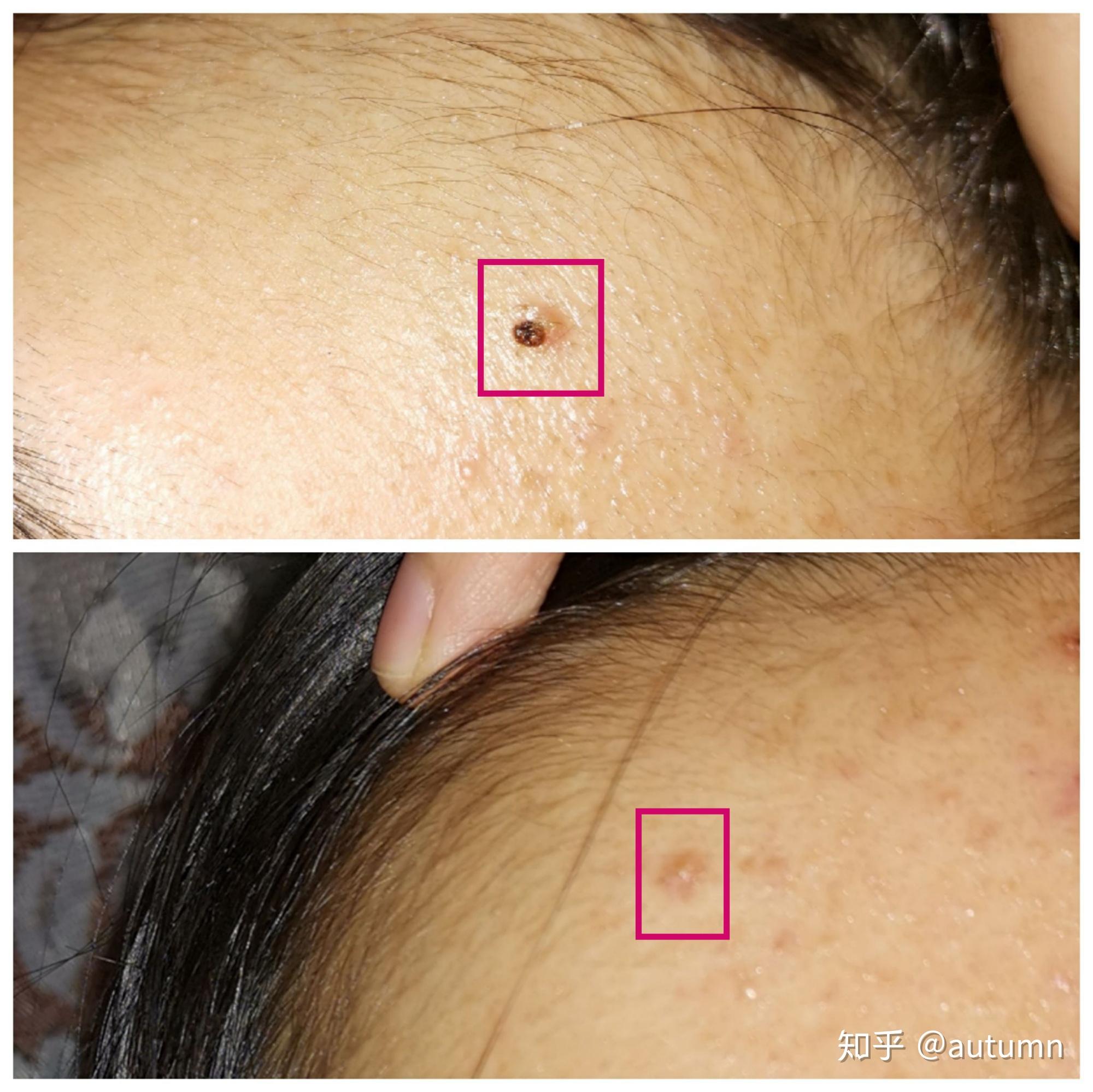 纪录我的第一次药水点痣