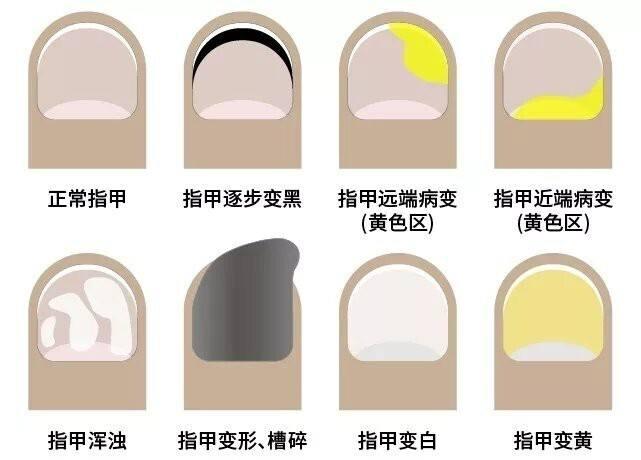 中草药根除灰指甲大剖析 | 满满的干货 - 知乎