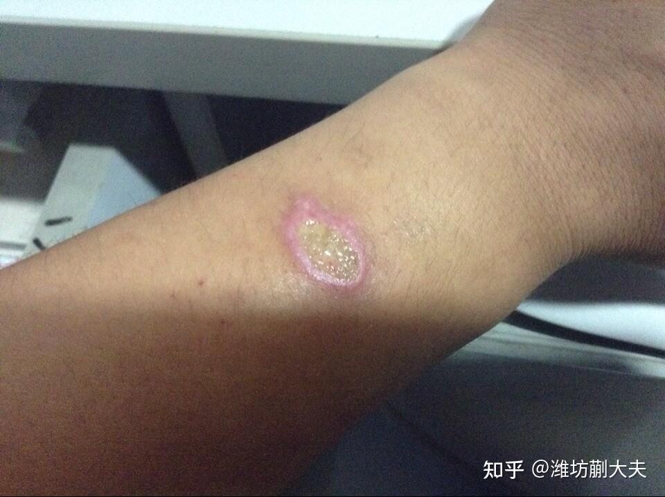 少不更事烟头烫伤手臂幸亏有修复技术