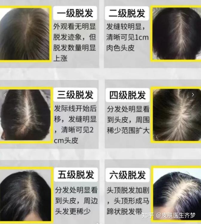 权威期刊《中国秃发指南》发布:预防防脱首选人参提取物!