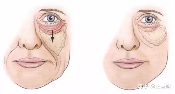 内窥镜小切口除皱术原来可以是这样啊!