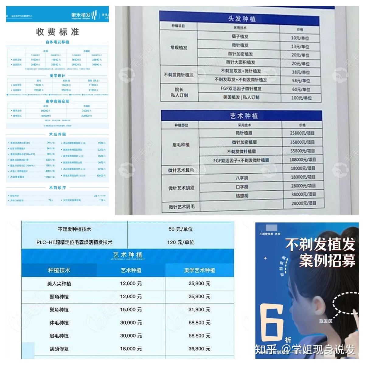沈阳植发怎么收费(沈阳植发医院哪家医技术好)