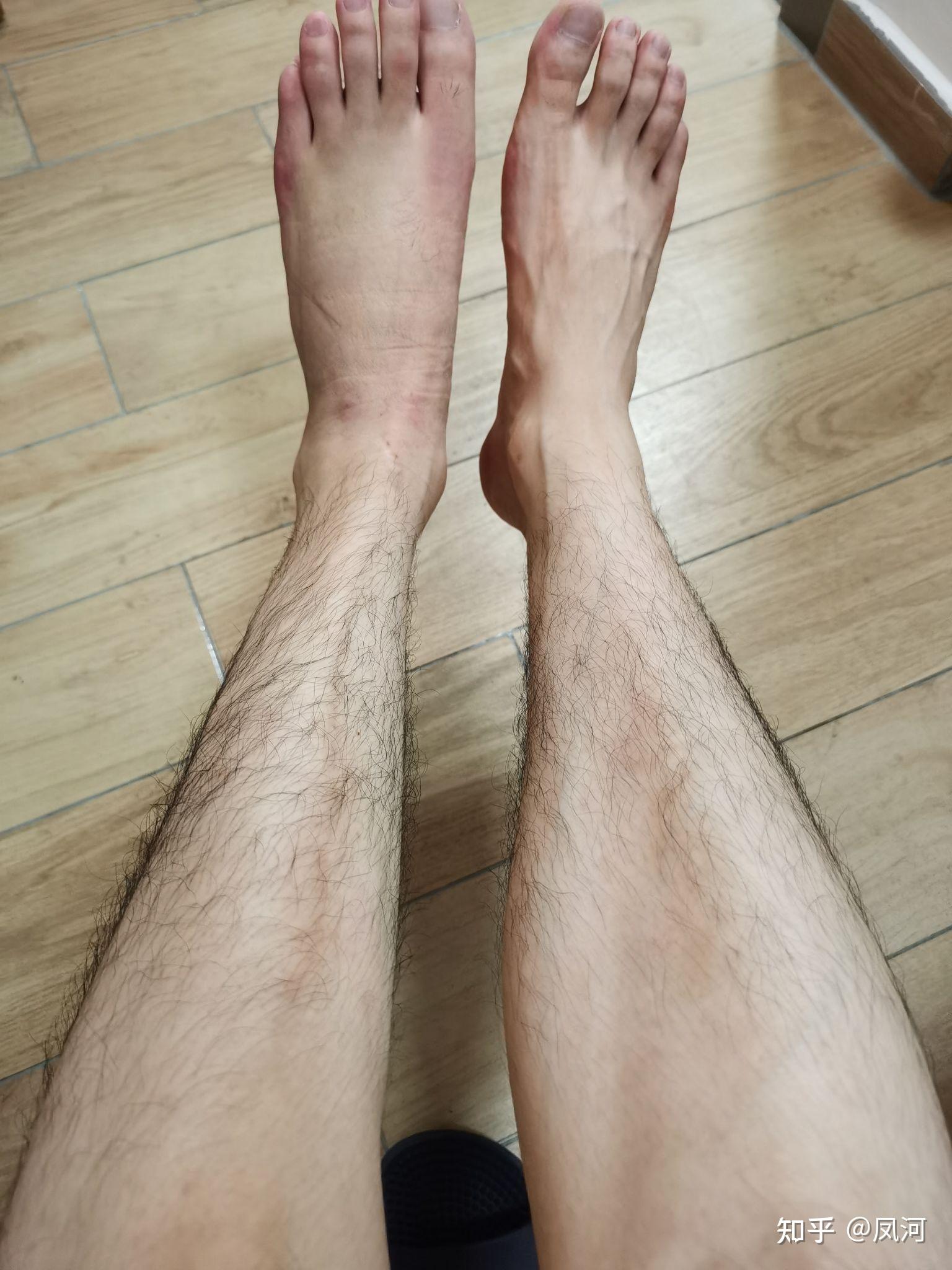 宁折不弯左脚第五跖骨基底粉碎性骨折随记三个月