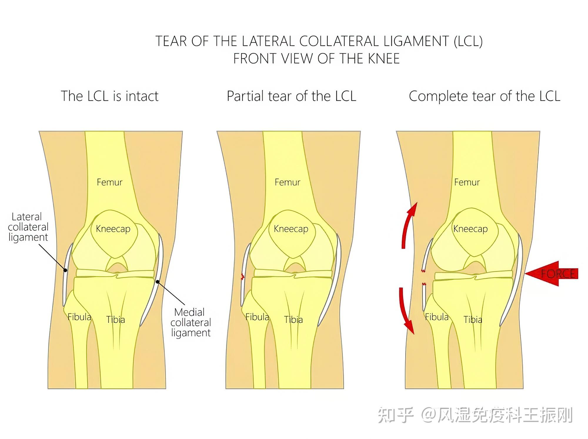 髕韌帶——髕韌帶為一強韌扁纖維帶,起自髕骨下緣和後面下部,向下止於