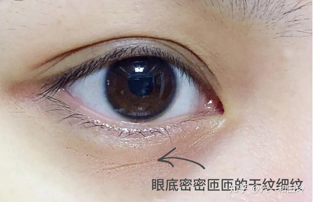 次数和各种表情,那一点点胶原蛋白很容易因为"过劳"丢失,鱼尾纹,泪沟