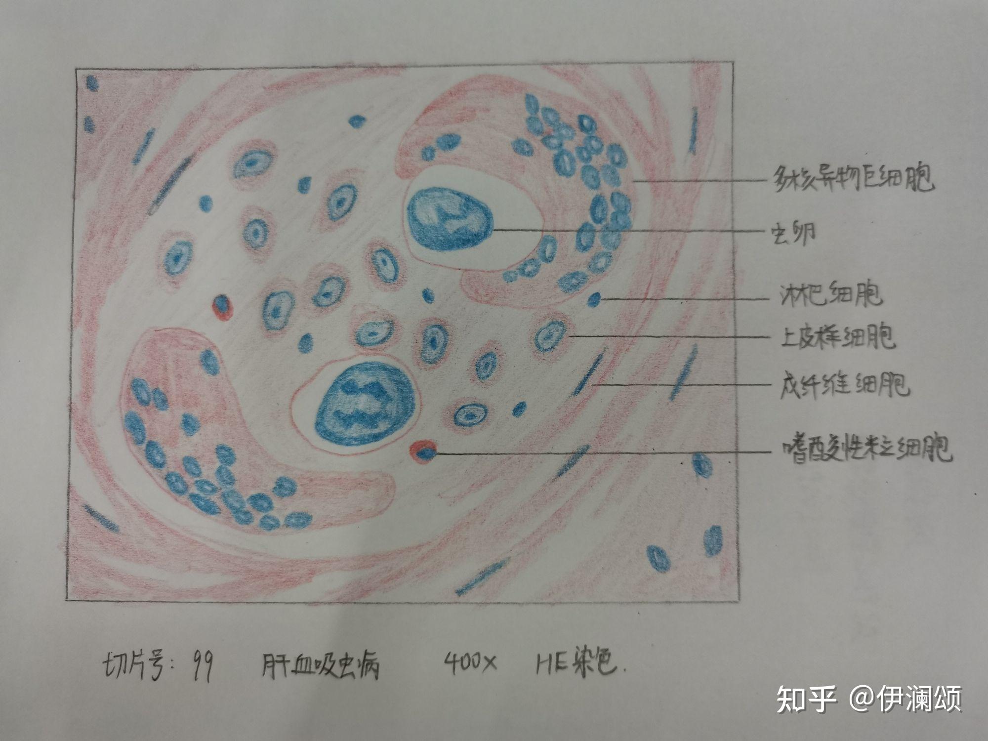 异物巨细胞红蓝铅笔图图片