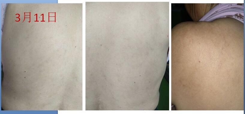 荨麻疹和湿疹的区别是什么?