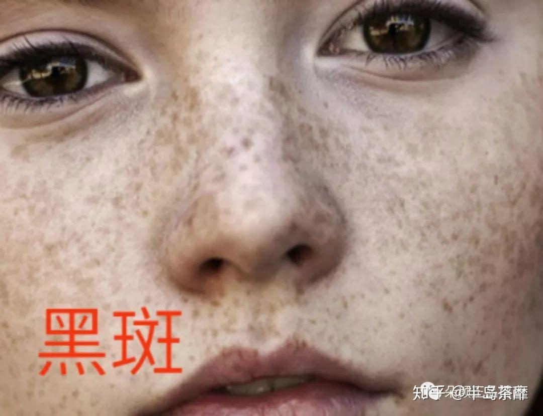 黑斑特点:呈点状,网状,片状,斑点较黑或深褐色.