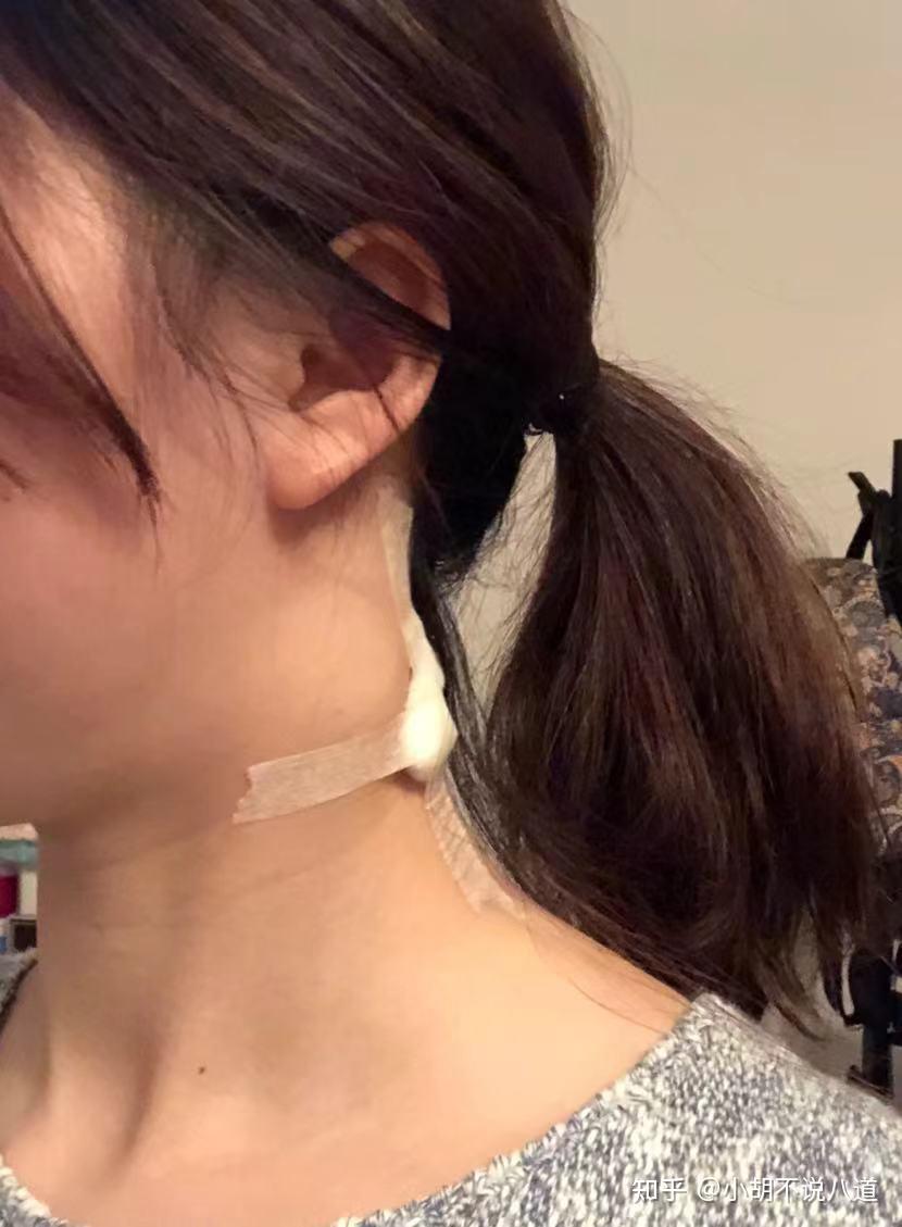 但是后面在抗结核治疗的过程中,出现了很多鼻咽癌的常见症状,这个我们