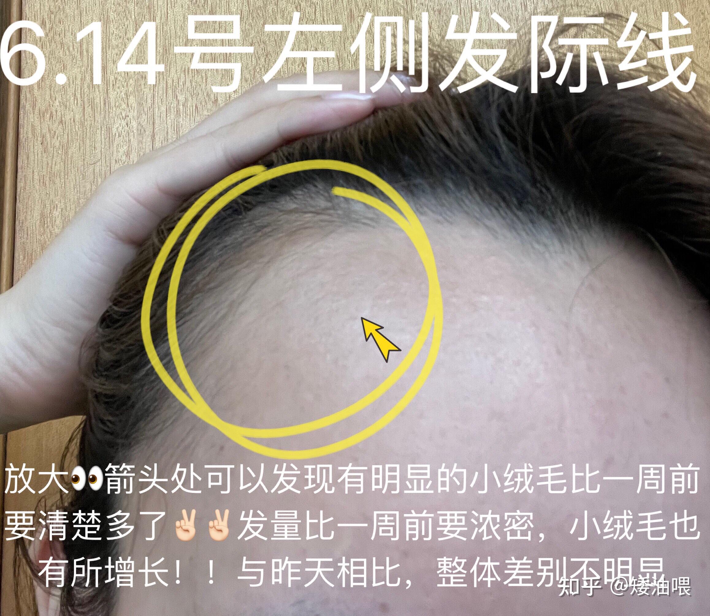 拯救发际线第74天明显解决发缝稀疏的问题改善发际线凹陷