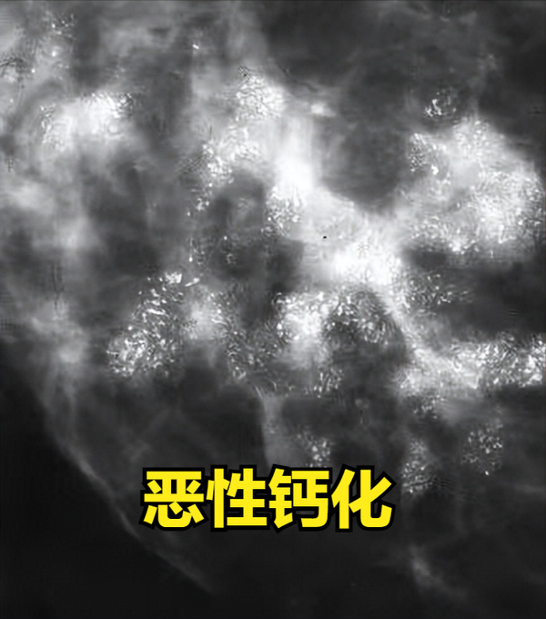 乳腺癌钼靶报告单该怎么看?教你读懂乳腺钼靶报告 - 知乎
