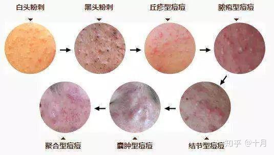 痘痘、痘坑、痘印的形成原因和治疗方法整理 - 知乎