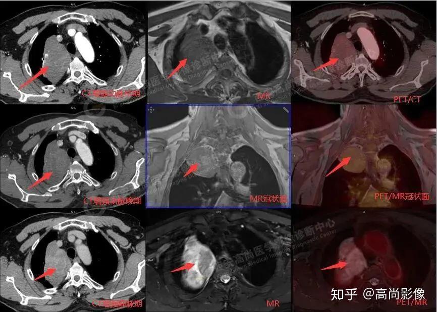 西安高尚医学影像petctmr多模态显像病例集锦第一期