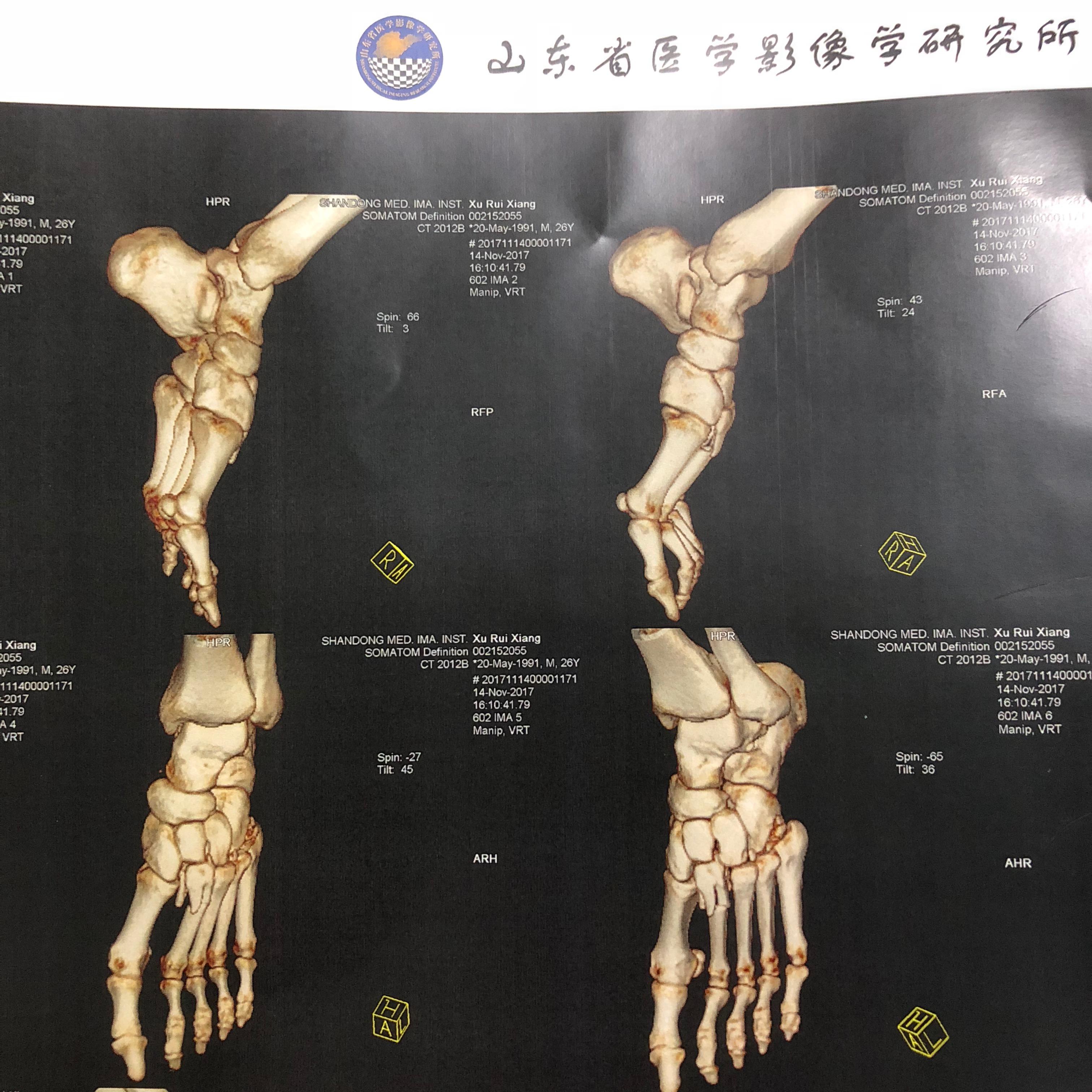 左脚第二跖骨骨折需要多久才能正常走路?