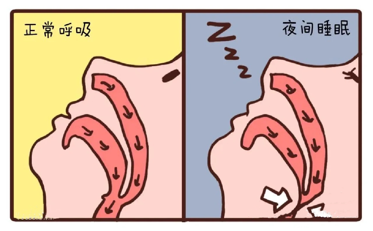 以前没有打鼾过，现在打呼特别严重，有什么办法可以不打呼噜? - 知乎
