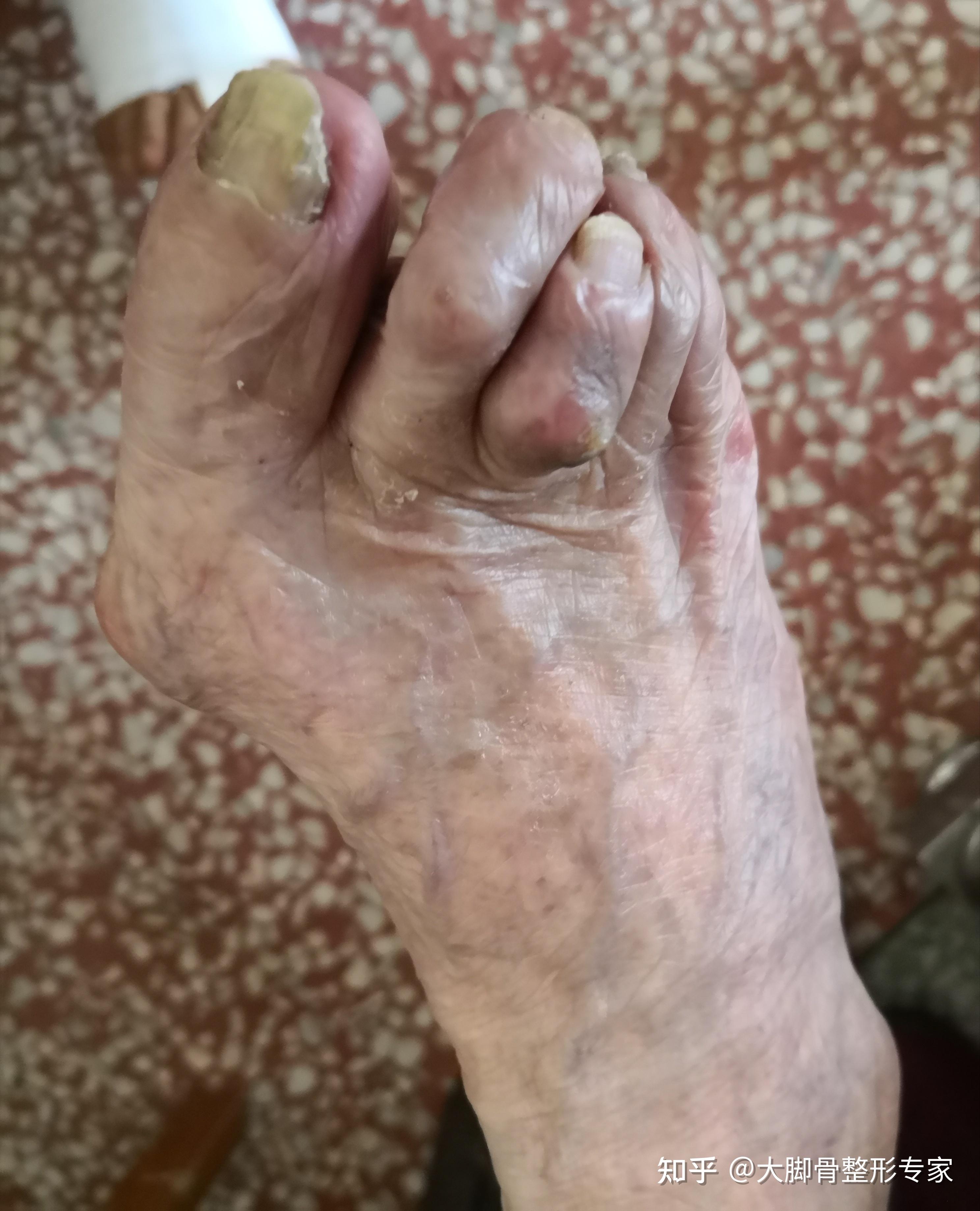 那些不做手术的拇外翻,会发展到怎么样 - 知乎