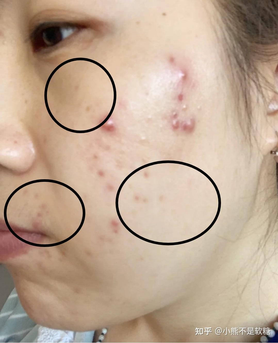 产生原因:黑色痘印形成的最大因素无外乎就是黑色素的沉积,这种痘印