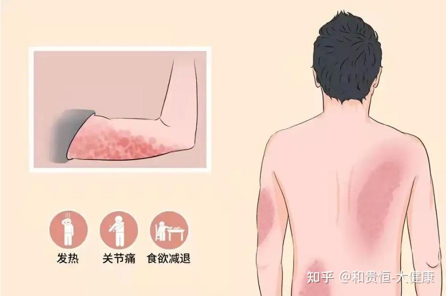 硬皮病科普 - 知乎