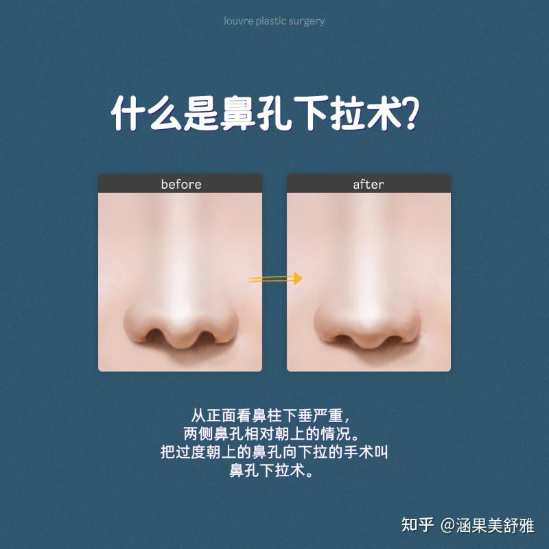 鼻孔下拉?朝天鼻如何改善? - 知乎