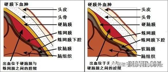 硬脑膜外血肿解剖图片