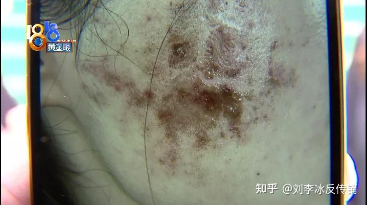 光子嫩肤脸上结痂聚美认为情况正常