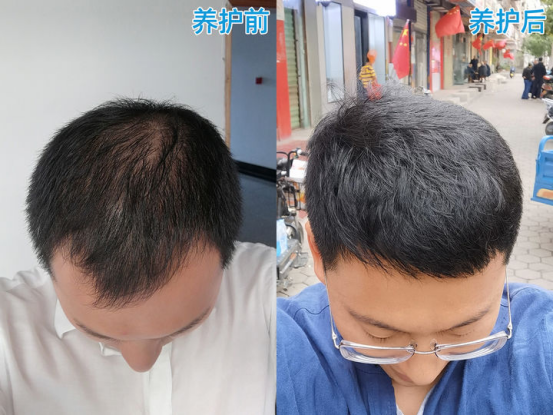 你们脱发最终是怎么好的