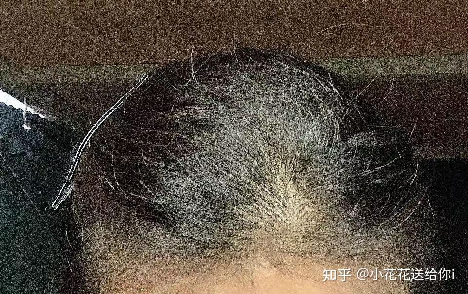 发质与发量的变化 - 知乎