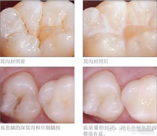 但并不是所有牙都需要做窝沟封闭,只有窝沟比较深