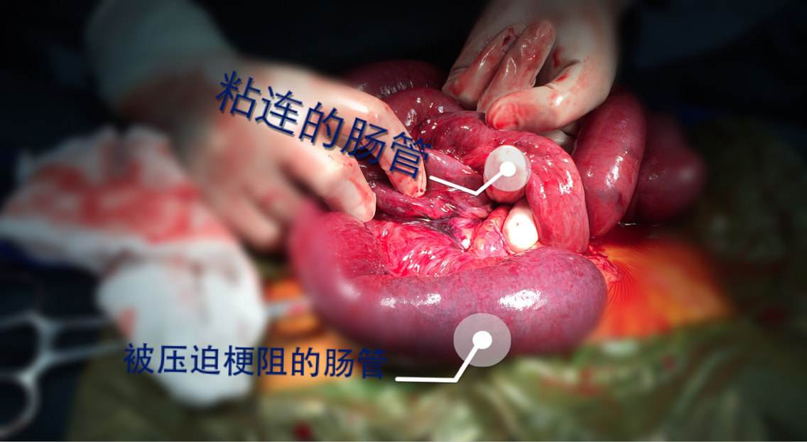 6点判断粘连性小肠梗阻手术时机