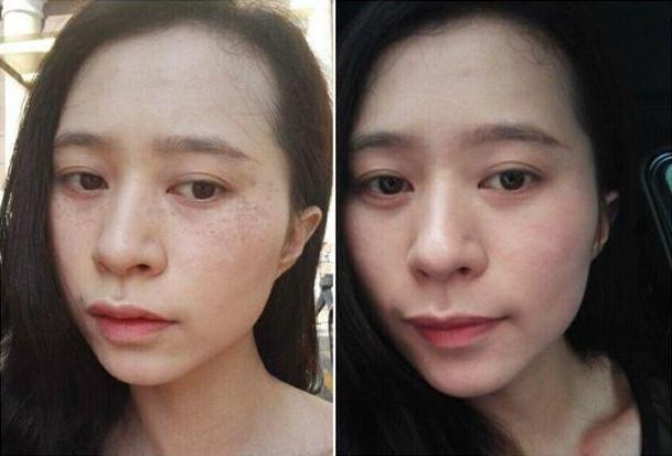 祛斑效果最好的排名第一精选十大祛斑排行榜总有一款适合你