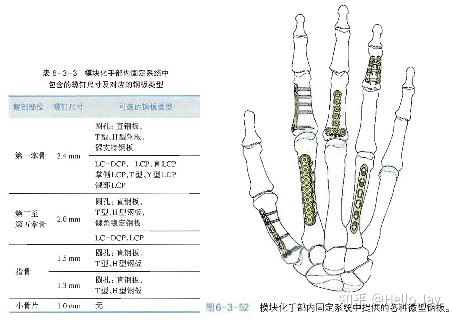 特殊部位骨折(近节指骨髁下骨折,中节指骨掌侧基底部骨折)1.