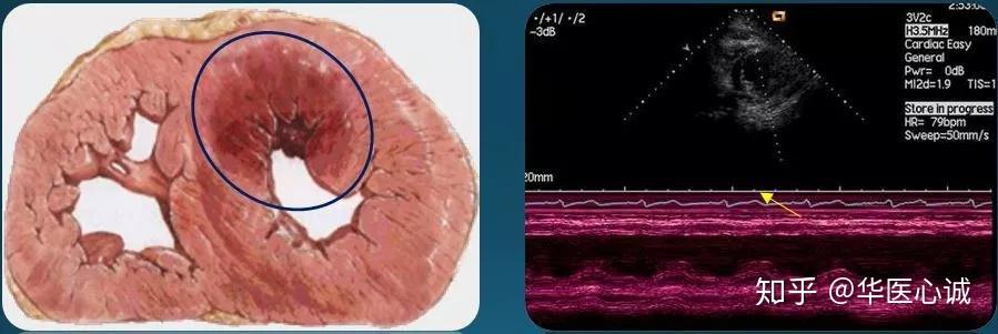 华医心诚超声心动图十大基本功:节段性室壁运动异常分析 - 知乎