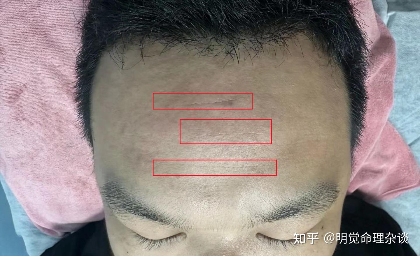 额头纹路，超重要！命好不好，就看这里！“川字纹”命超好，但此纹会苦一辈子！ - 知乎