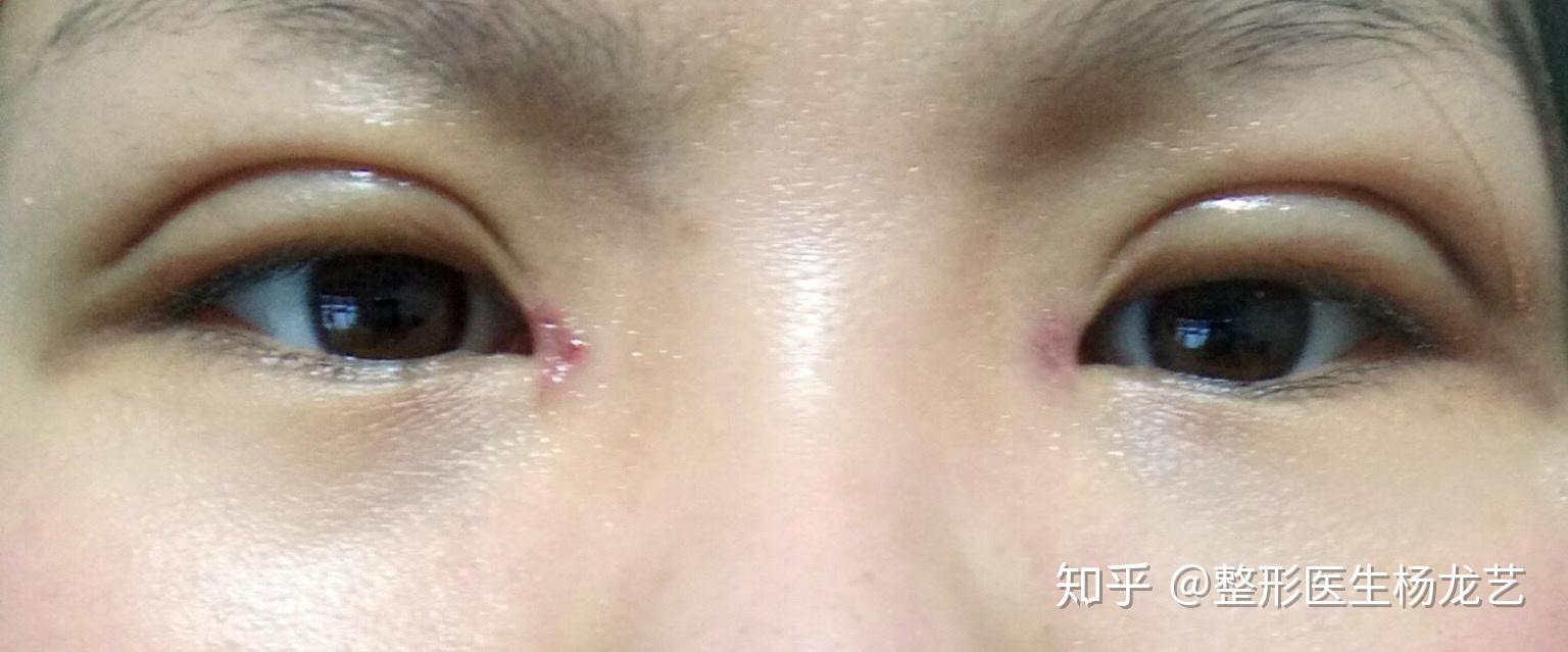 开完眼角的一个月左右比较受煎熬,这个时期内眼角疤痕会有明显的凸起