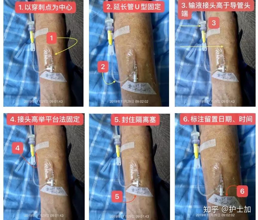 图文并茂:一文搞定留置针固定的7个要点! - 知乎