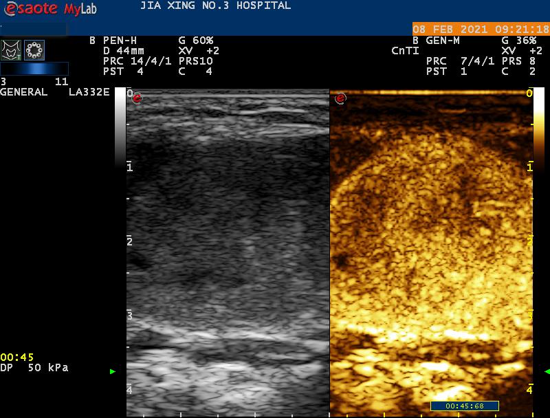 精选病例1超声引导下甲状腺多发结节射频消融术穿刺硬化术